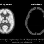 Mengenal Istilah Brain Death