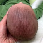 Penyebab Bayi Mengalami Plagiocephaly dan Brachycephaly